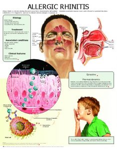 Allergic-rhinitis