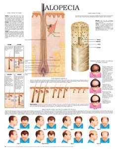 Alopecia