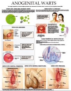 Anogenital-Warts