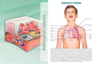 Asthma-in-infants