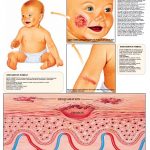 Atopic-Dermatitis