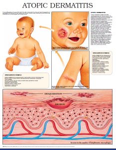 Atopic-Dermatitis