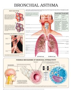 Bronchial-asthma