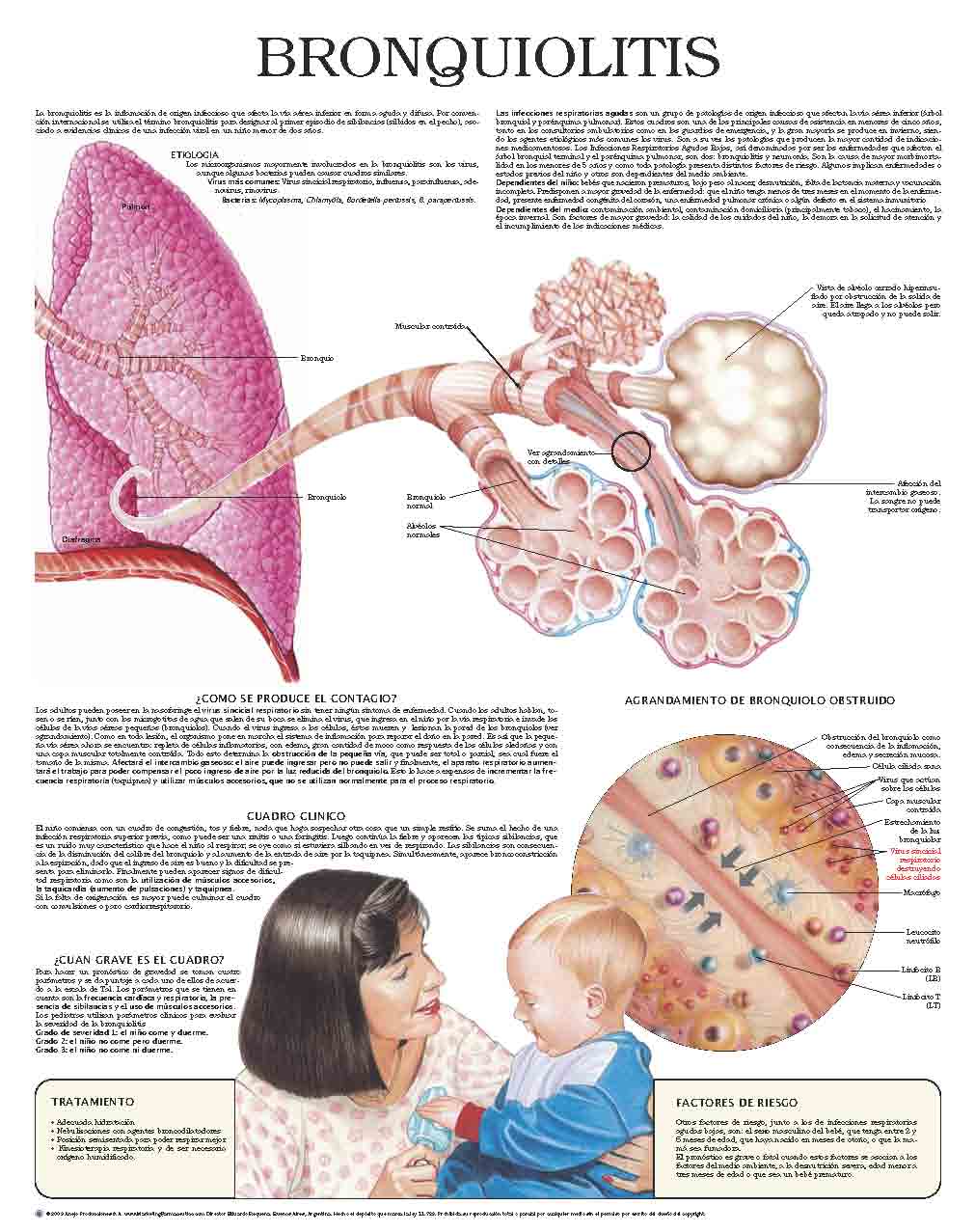 Bronchiolitis