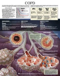 Chronic-Obstructive-Pulmonary-Disease-COPD-2