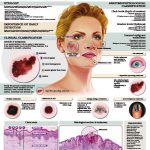 Cutaneous-Melanoma