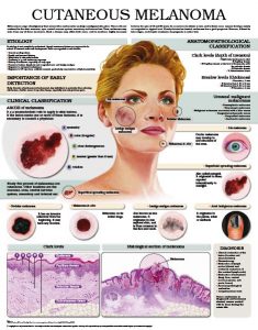 Cutaneous-Melanoma