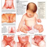 Diaper-Dermatitis