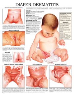 Diaper-Dermatitis