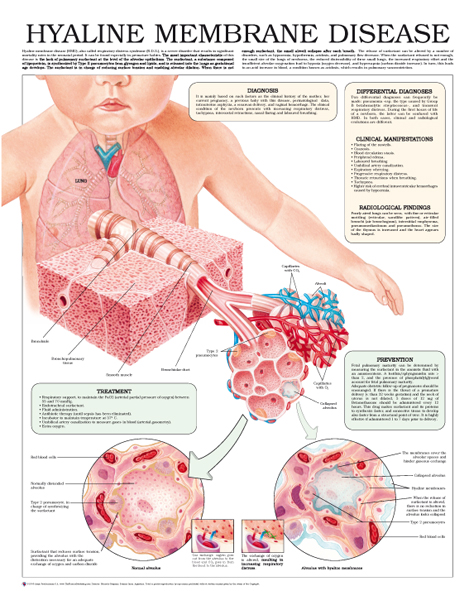 Hyaline-membrane-disease