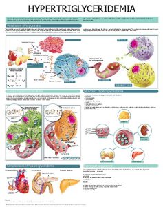 Hypertriglyceridemia