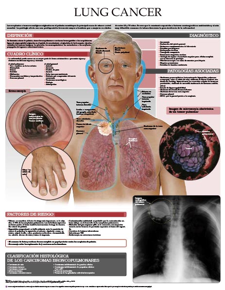 Lung-cancer