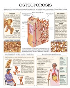 Osteoporosis-3