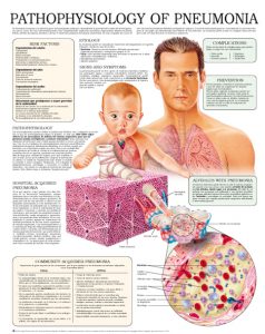 Pathophysiology-of-pneumonia