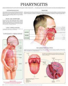 Pharyngitis