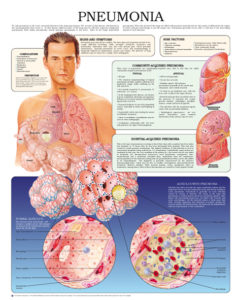 Pneumonia