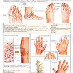 Psoriatic-Arthritis