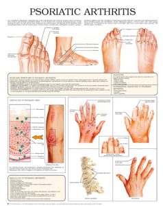 Psoriatic-Arthritis