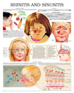 Rhinitis-and-sinusitis