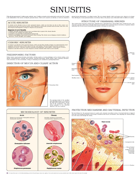 Sinusitis