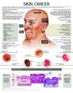 Skin-Cancer