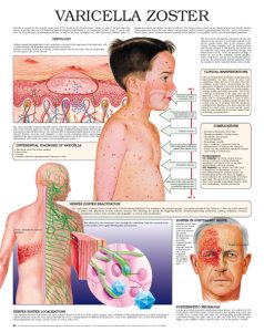 Varicella-Zoster