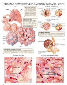 chronic-obstructive-pulmonary-disease–COPD