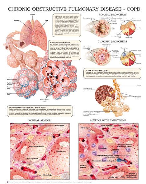 chronic-obstructive-pulmonary-disease–COPD